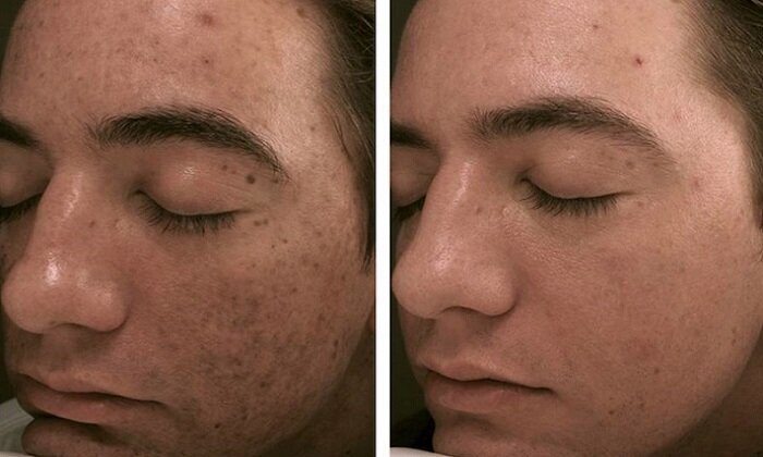micropen-microneedling-before-and-after-1