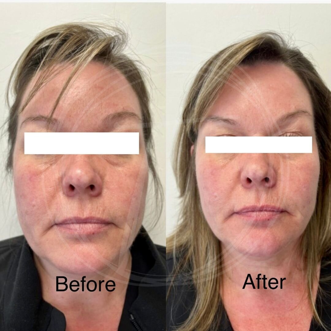 before:after results with look timeless - 3