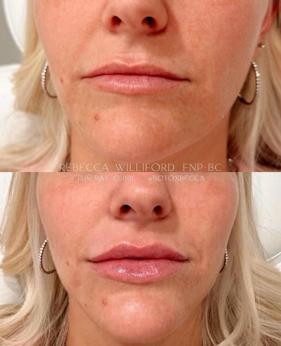 Lip Filler by Rebecca Williford at The Rae Clinic in Augusta, Georgia