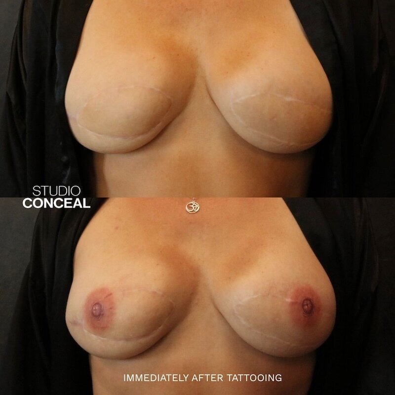 BW Post Mastectomy Tattoo 1