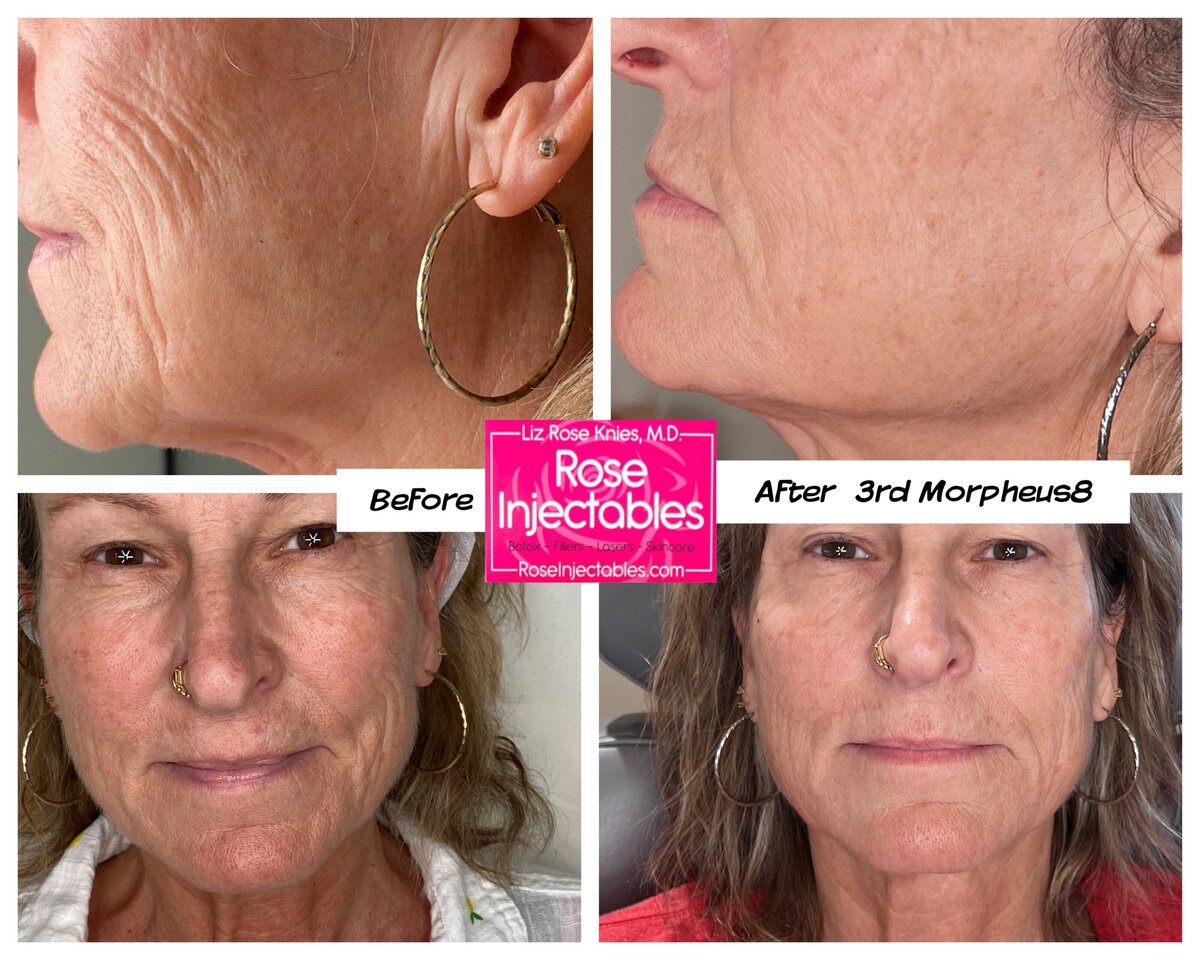 Morpheus8-by-Rose-Injectables-Before-and-After-Photos-4
