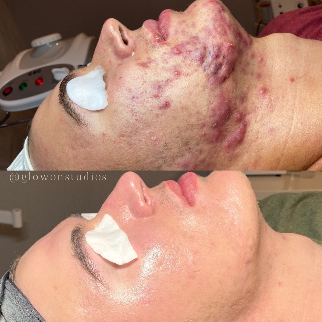 Glow-On-Studios-Before-After-Skincare-Sacramento