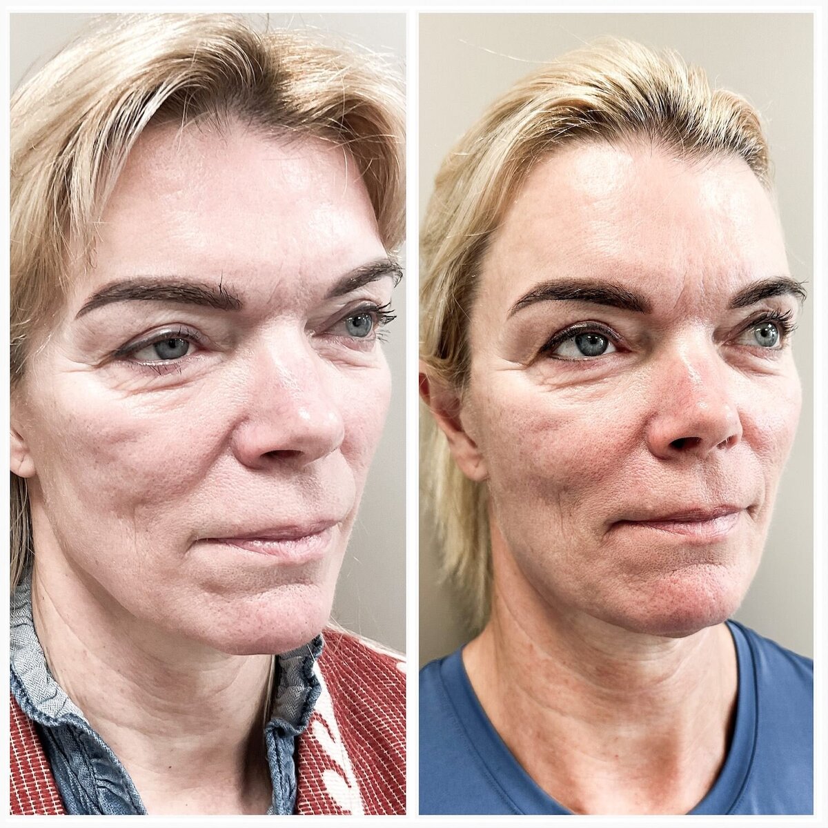 Liquid facelift door Lizenka Adriaanse cosmetisch arts Rotterdam1