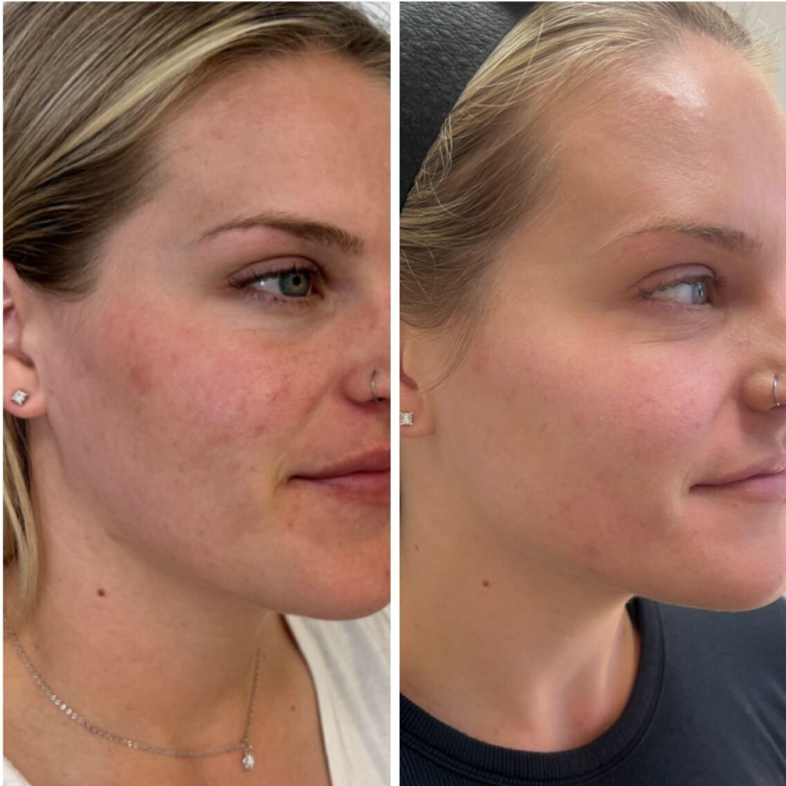compressed-Moxi- BBL-before-after-16