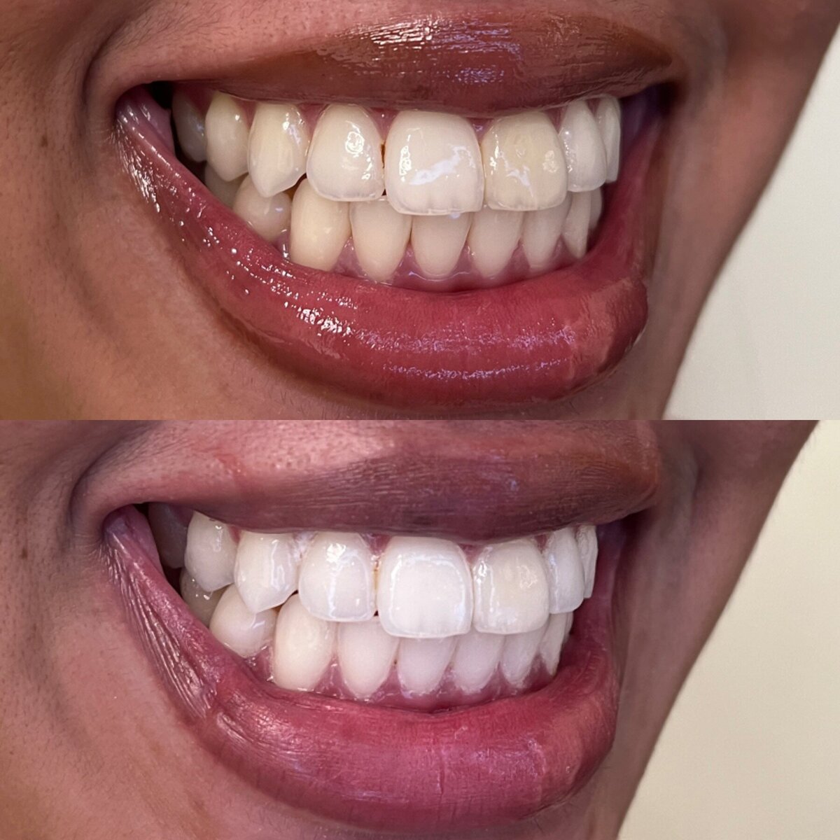 teeth whitening portland oregon or pdx tooth fairy