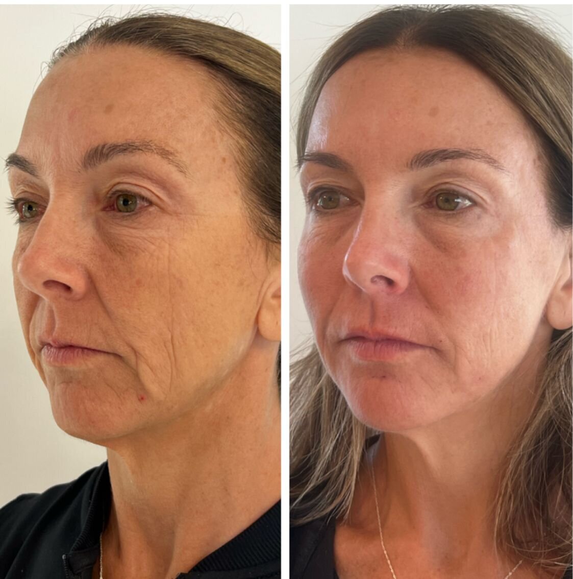 compressed-Hyperdilute-Radiesse-brand-and-before-after-06