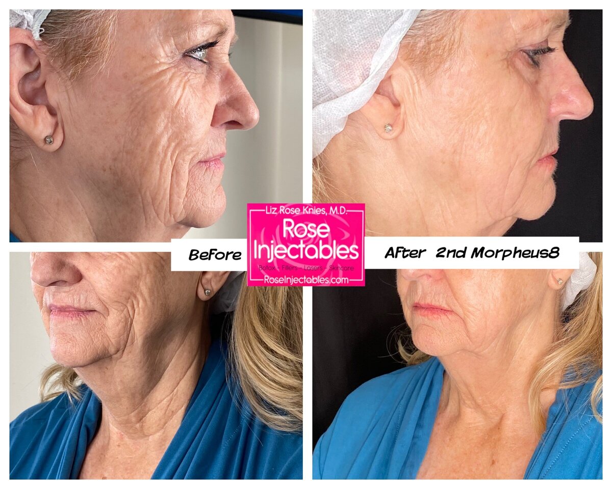 Morpheus8-by-Rose-Injectables-Before-and-After-Photos-35