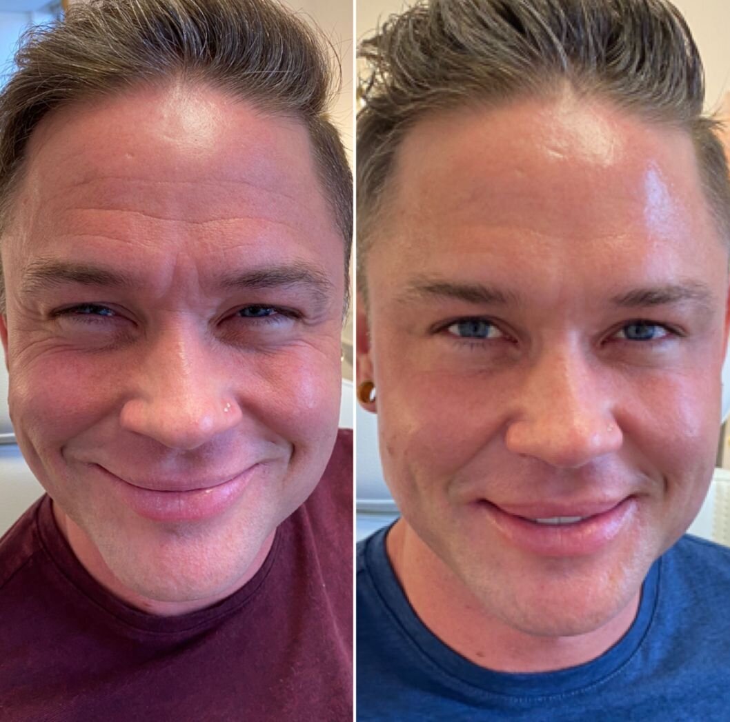 compressed-Neuromodulator-before-after-08