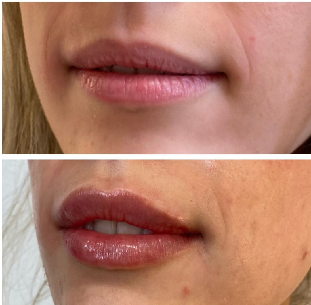 compressed-Lip-Wrinkles- Lip-volume-nd-some-brand-pics-07