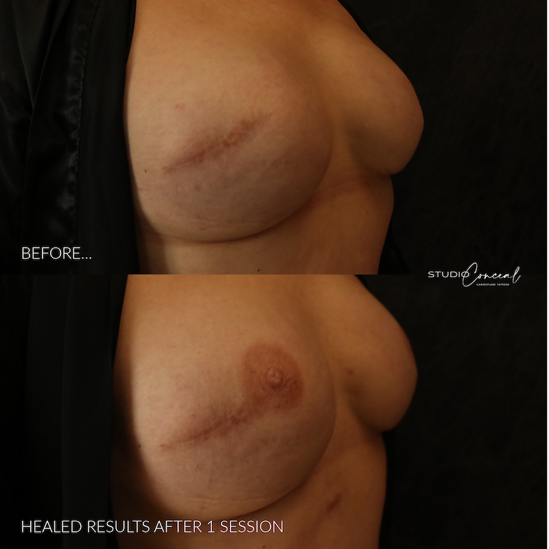 POST-MASTECTOMY4