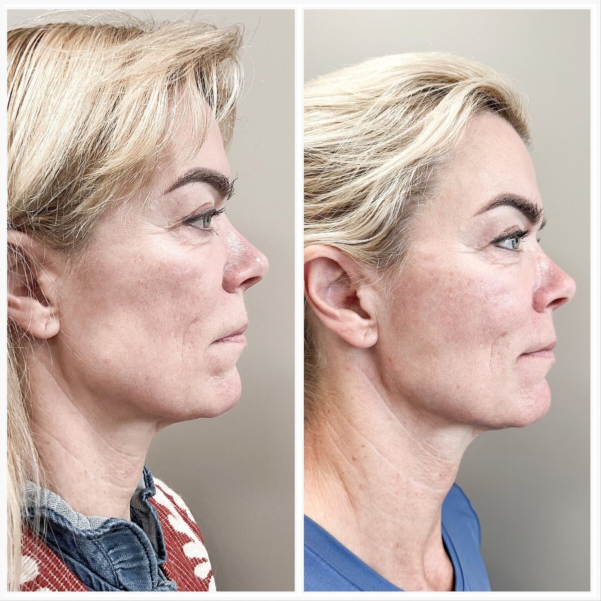 Liquid facelift door Lizenka Adriaanse cosmetisch arts Rotterdam5
