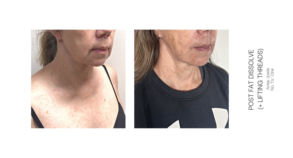 Jowls Fat Dissolve Before and After