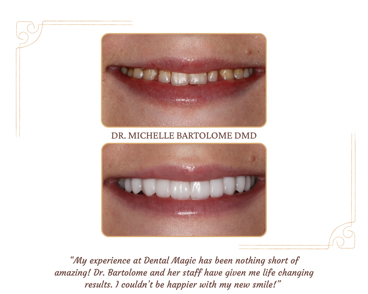 Smile Transformation