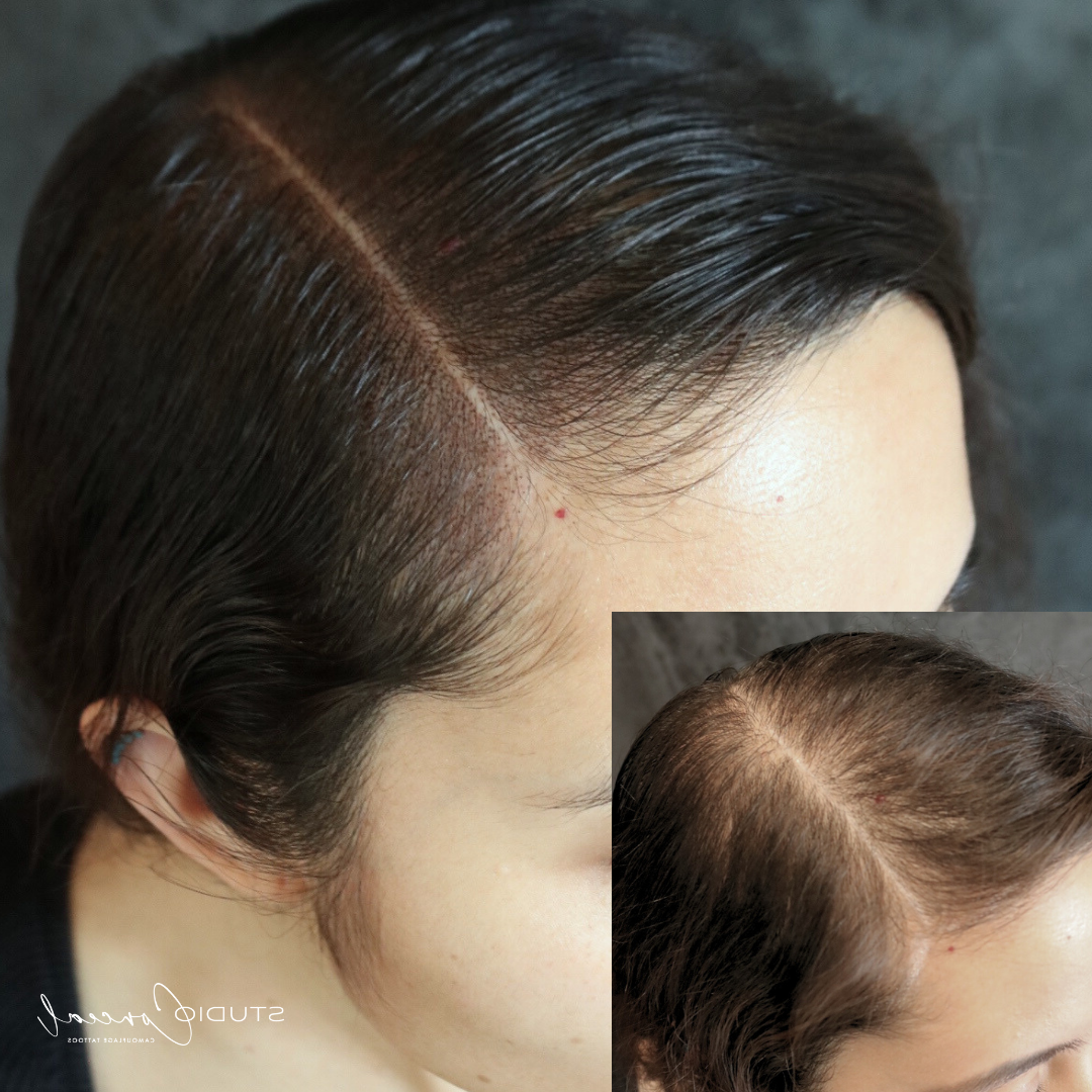 female-hair-density-treatment-in-arizona-e1730424432452