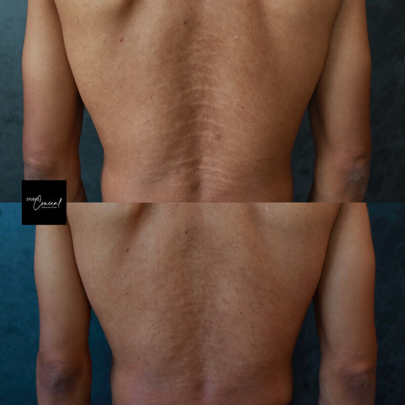 Male-stretch-marks-back-1