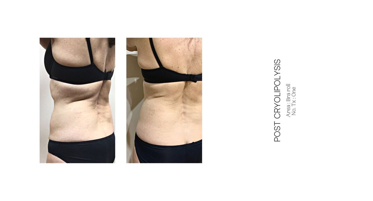 Cryolipolysis Bra Roll Before and After 2