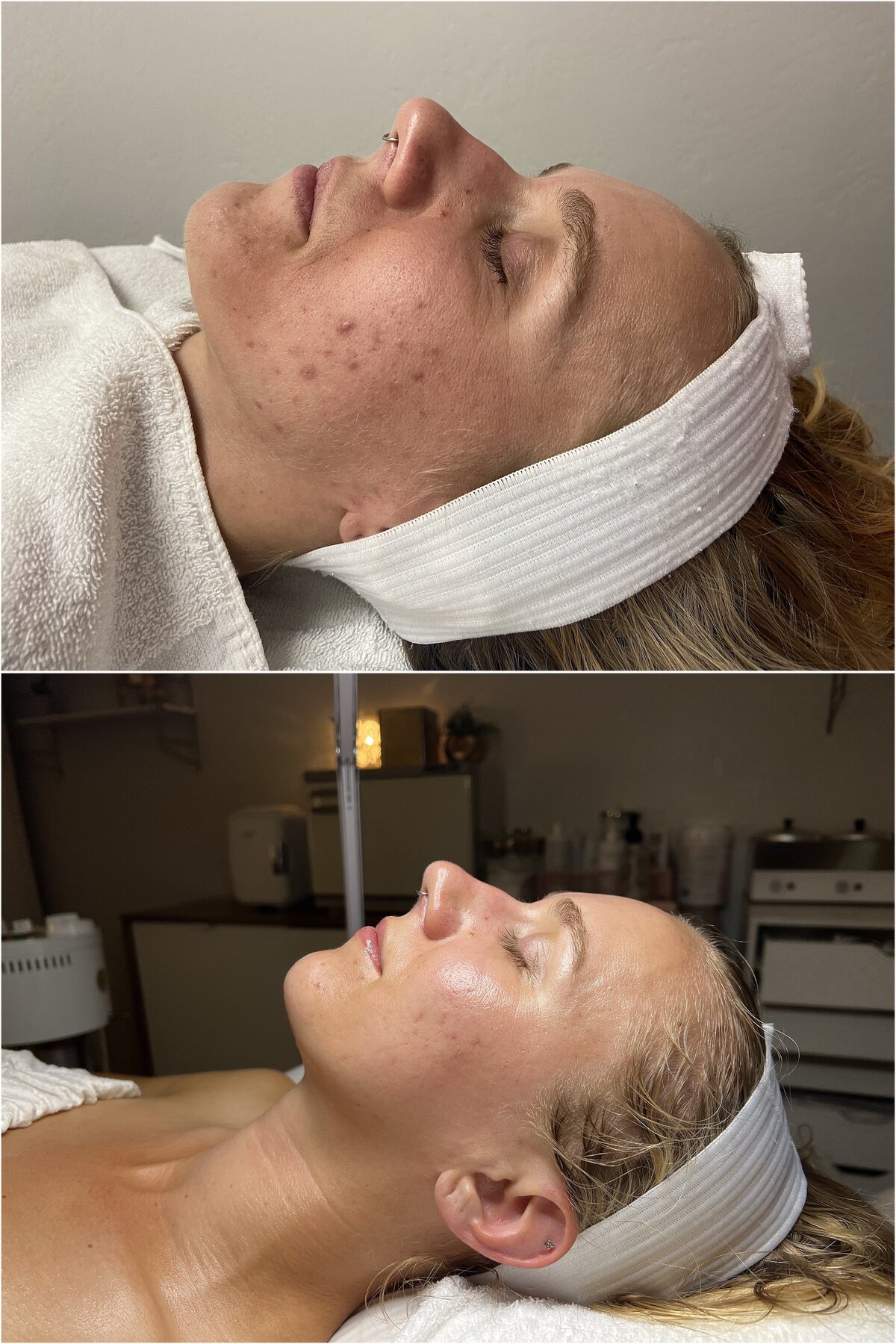 MK Studios_Allure AZ_acne-treatment-flagstaff-az-before-after_0022
