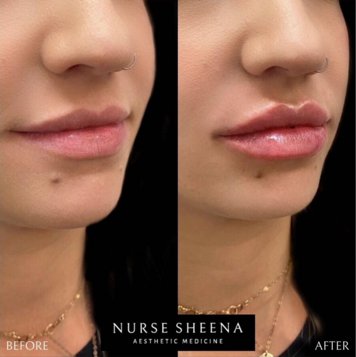 Lip Filler Results 6 by Nurse Sheena
