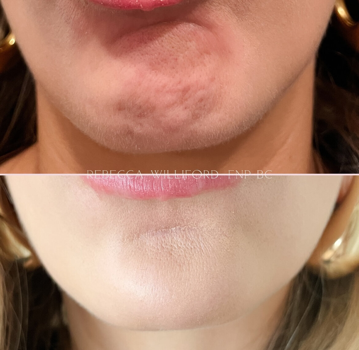 Chin Botox by Rebecca Williford at The Rae Clinic in Augusta, Georgia