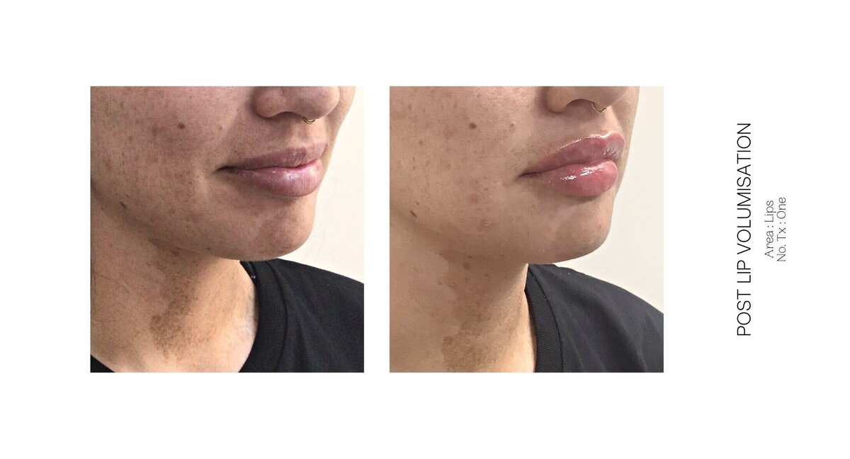 Best South Coast Lip Injection Before and After 32