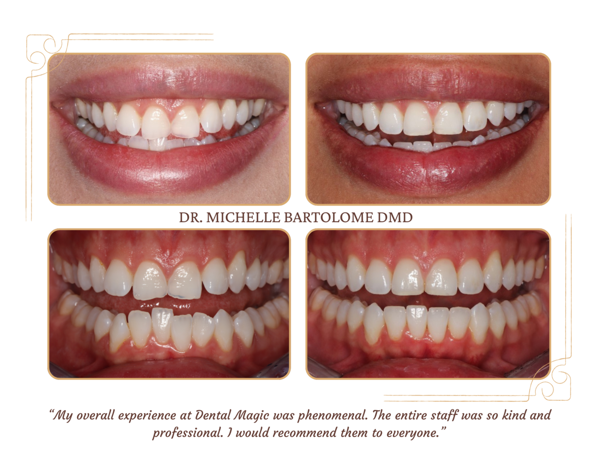Invisalign (2)