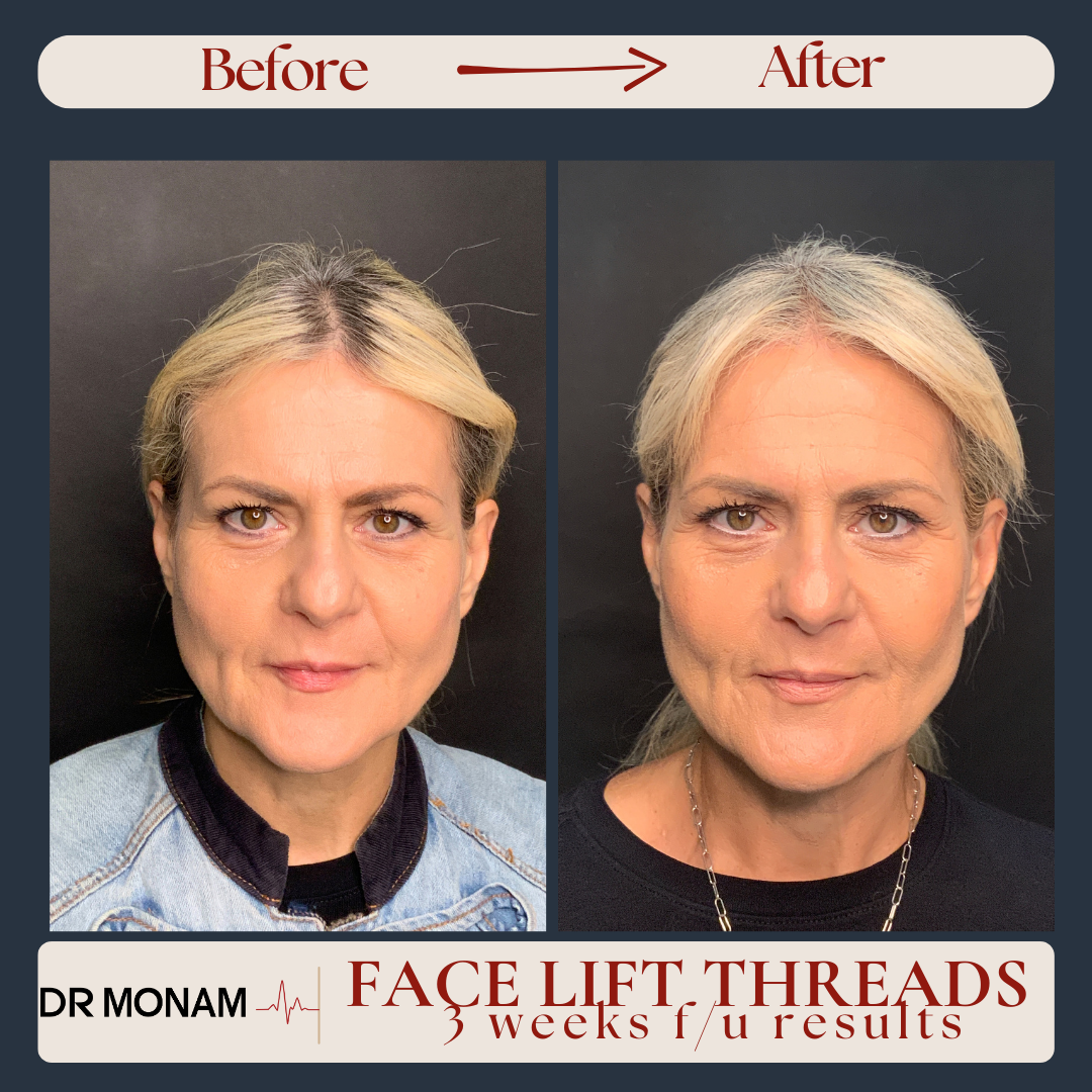 Neutral Before and After Instagram Post-23