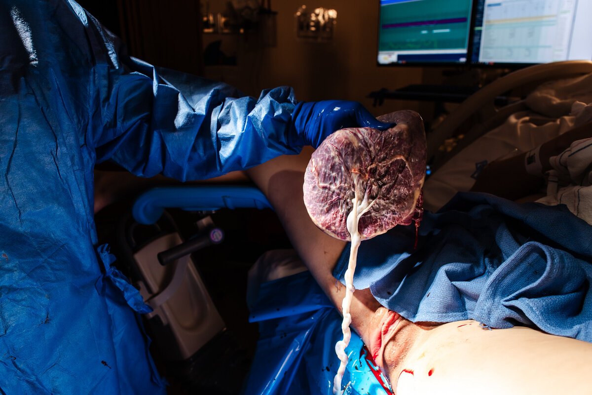 A placenta is birthed after baby is born.  The doctor holds it up in the light.  Modesto Doula, Shayna Cox, was there to support this birth. 