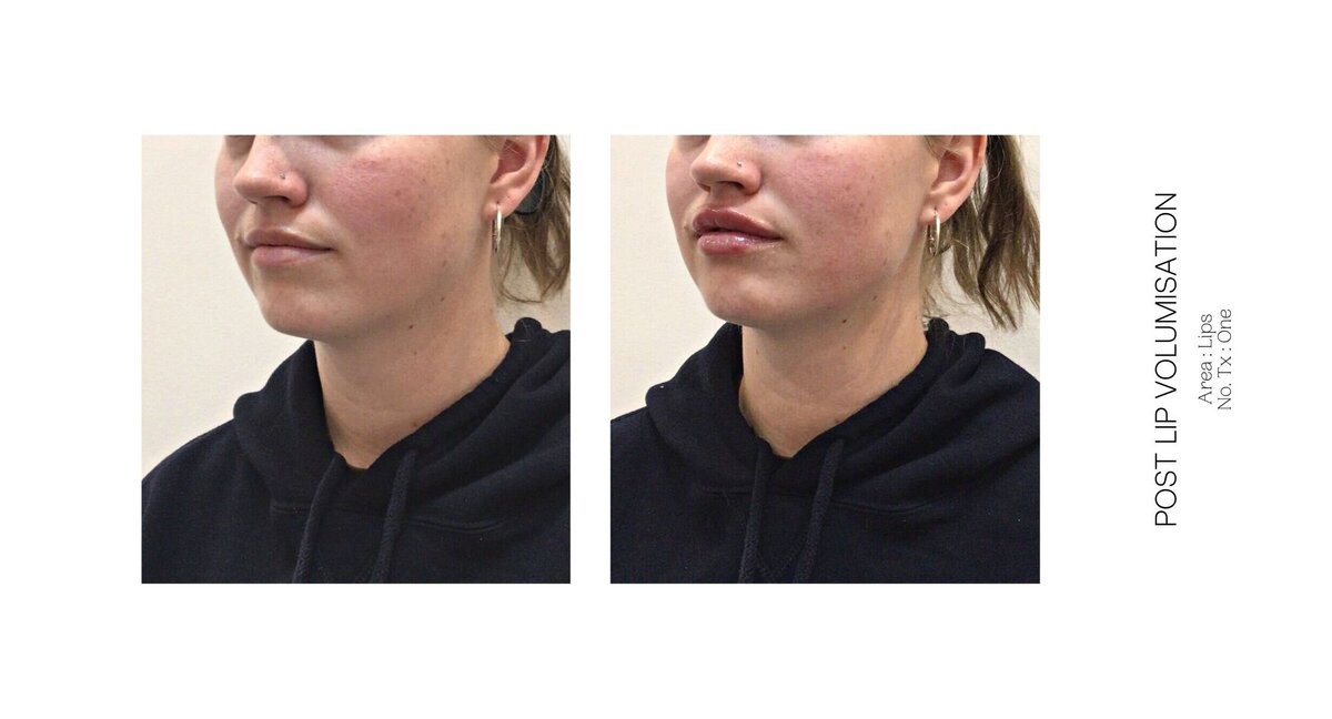 Best South Coast Lip Injection Before and After 5
