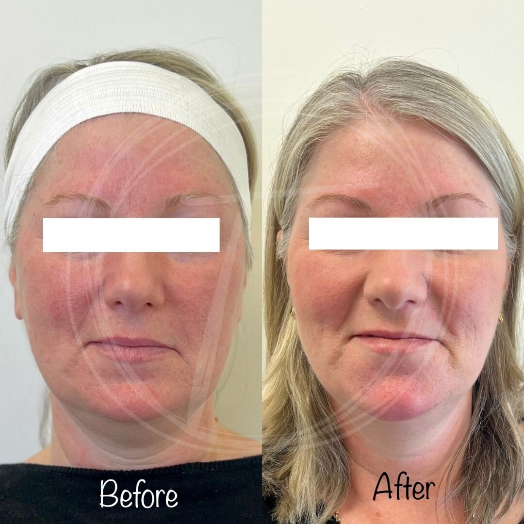 before:after results with look timeless - 12