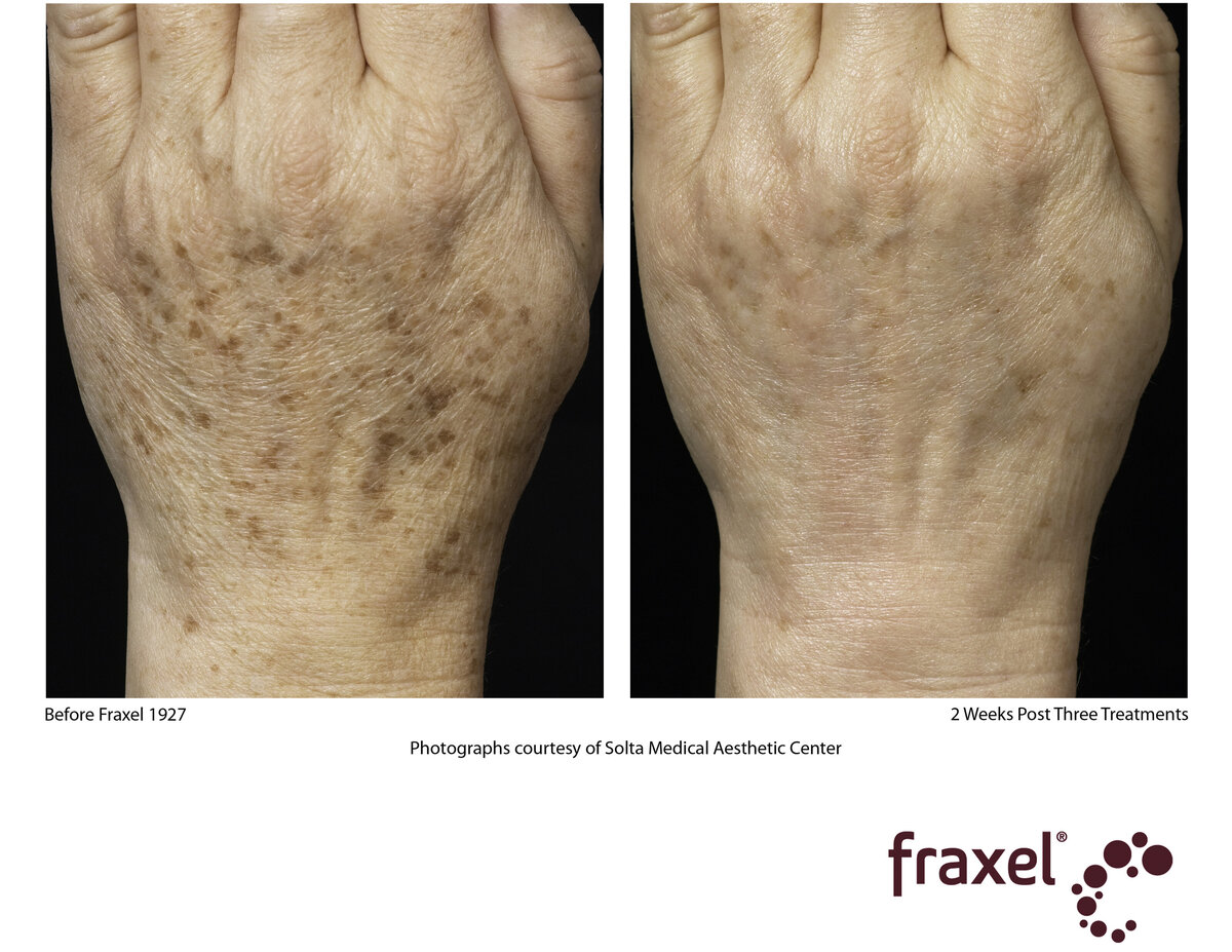 0142-Fraxel_1927_HiRes