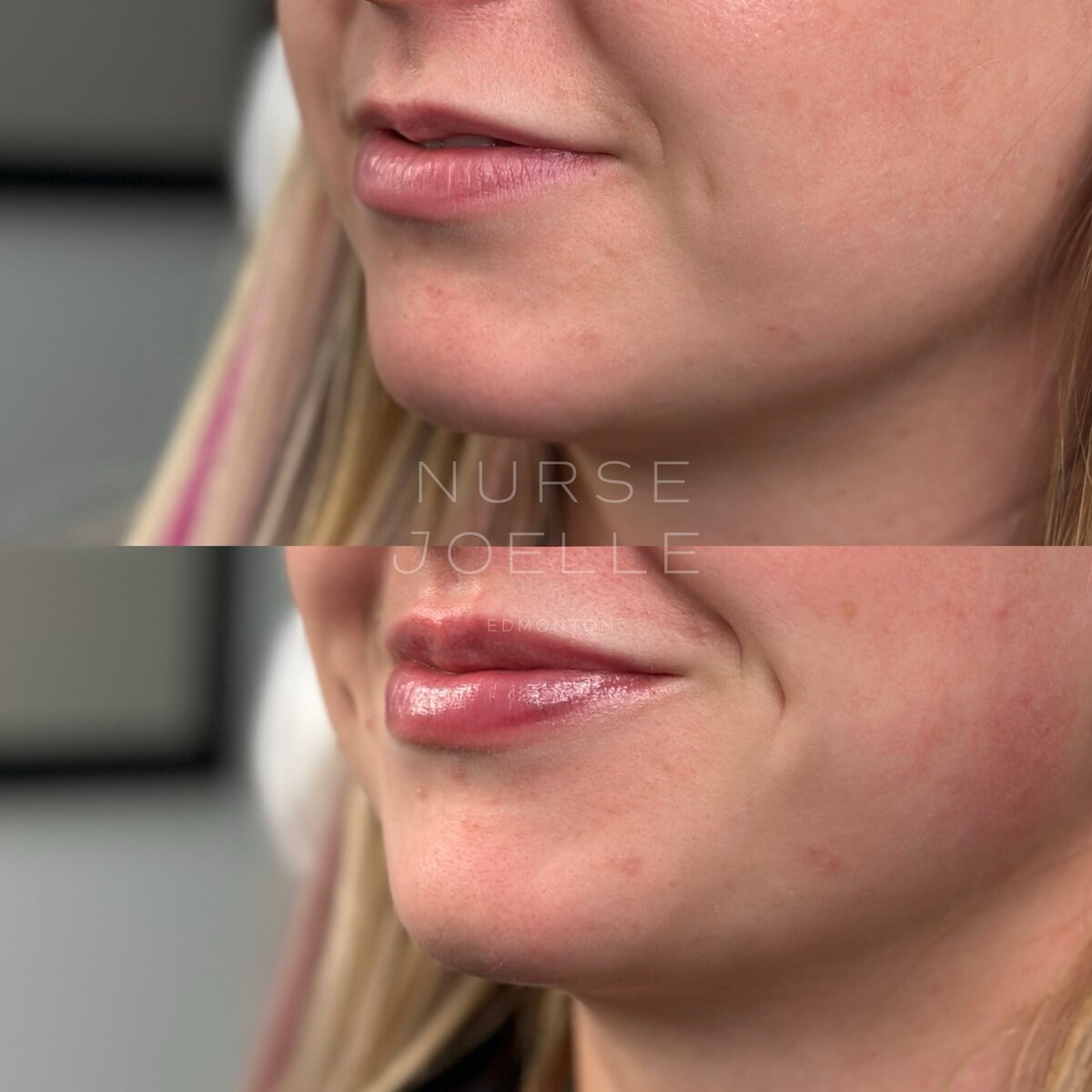 Nurse-Joelle-Lip-Fillers-Before-After