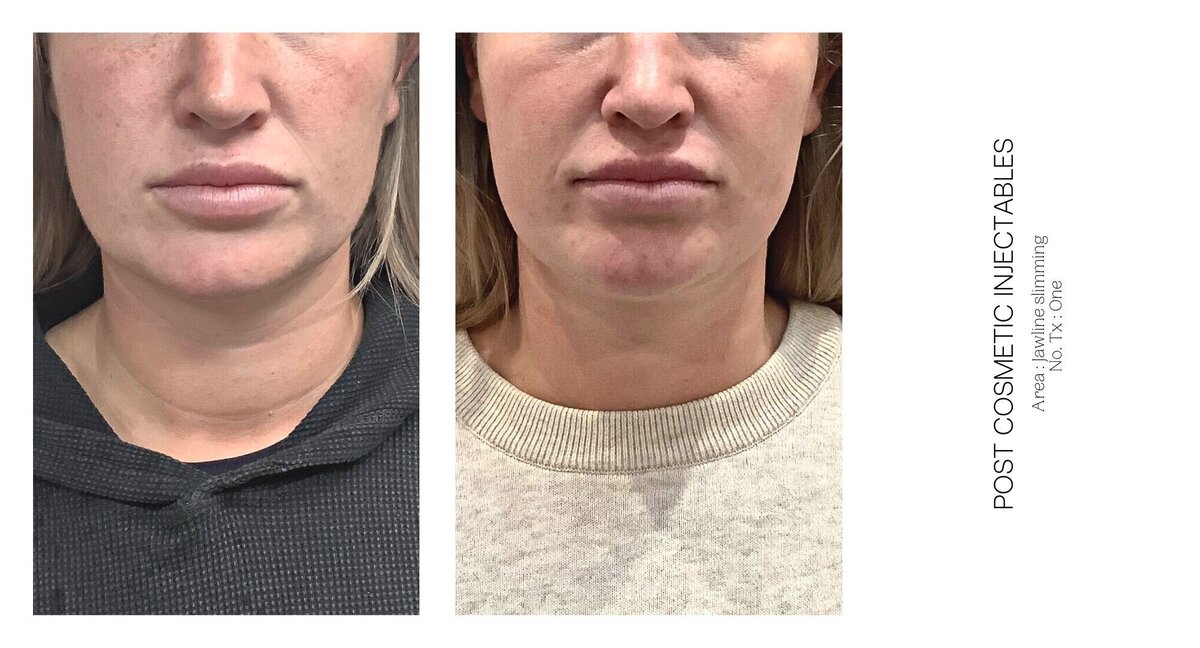Best Cosmetic Injectable Jaw Line Before and After 1
