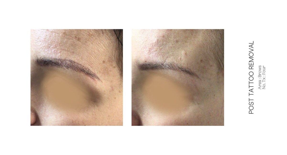 Brow Tattoo Removal Before and After
