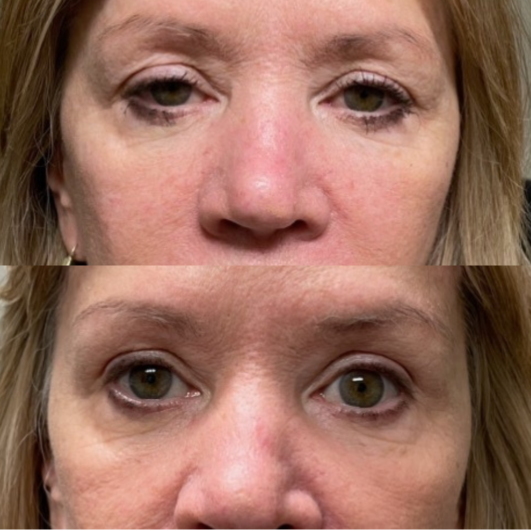 Pretrichial brow ptosis repair(1)