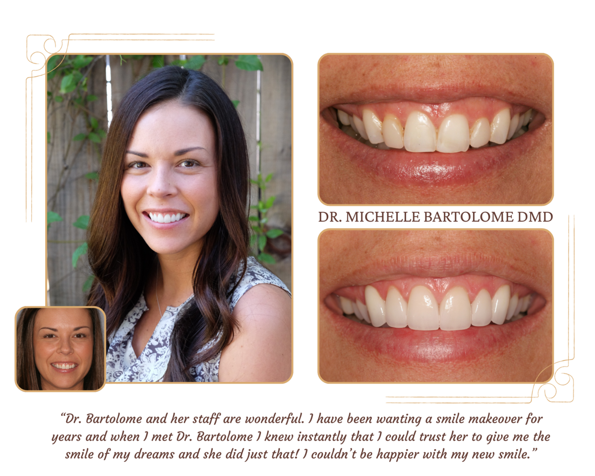 Crowns and Veneers