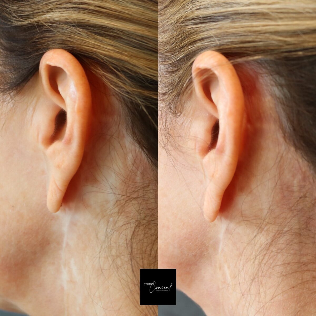 scar camouflage