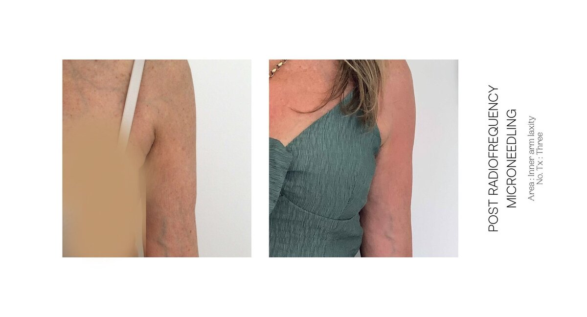 Radiofrequency and Miconeedling Before and After