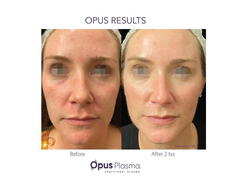 Opus Results Picture 7