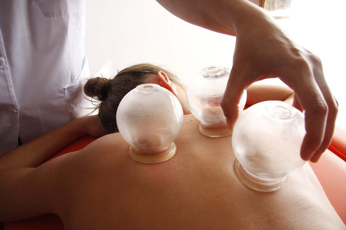 Cupping Services at FM Acupuncture, Moorhead, MN
