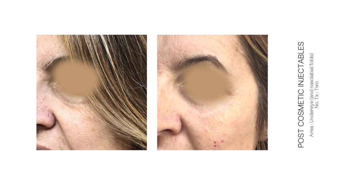 PRP Under Eye Before and After 4