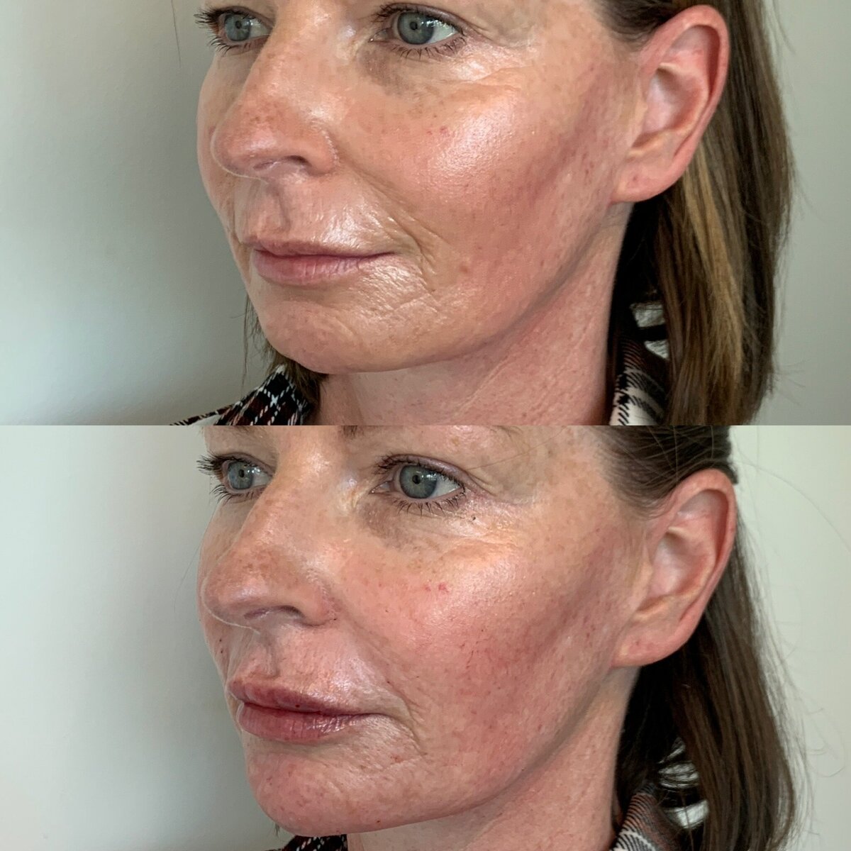 BalancedBeautyBotoxWestwood10