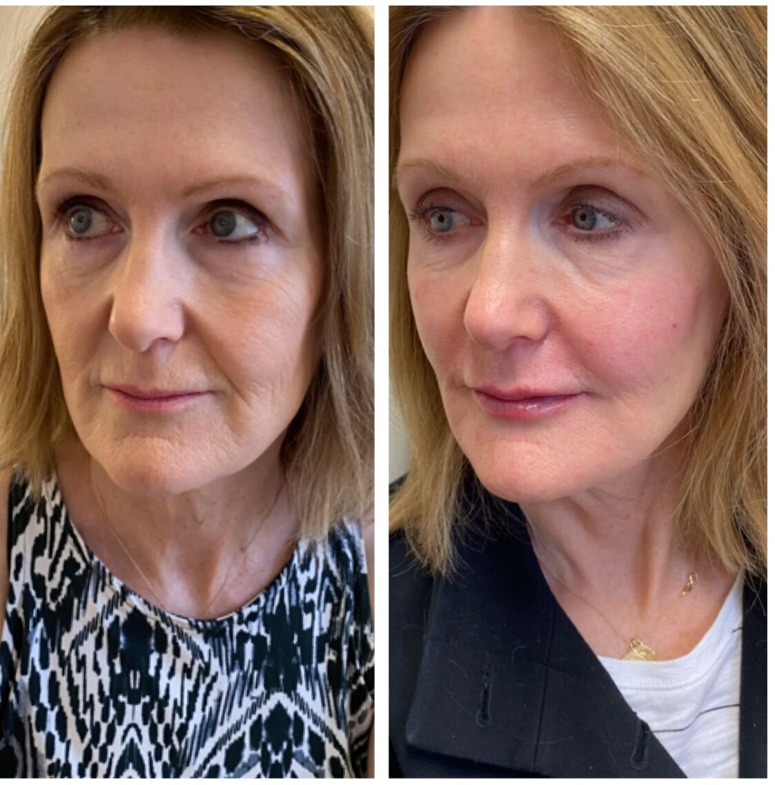 compressed-halo-before-after-05