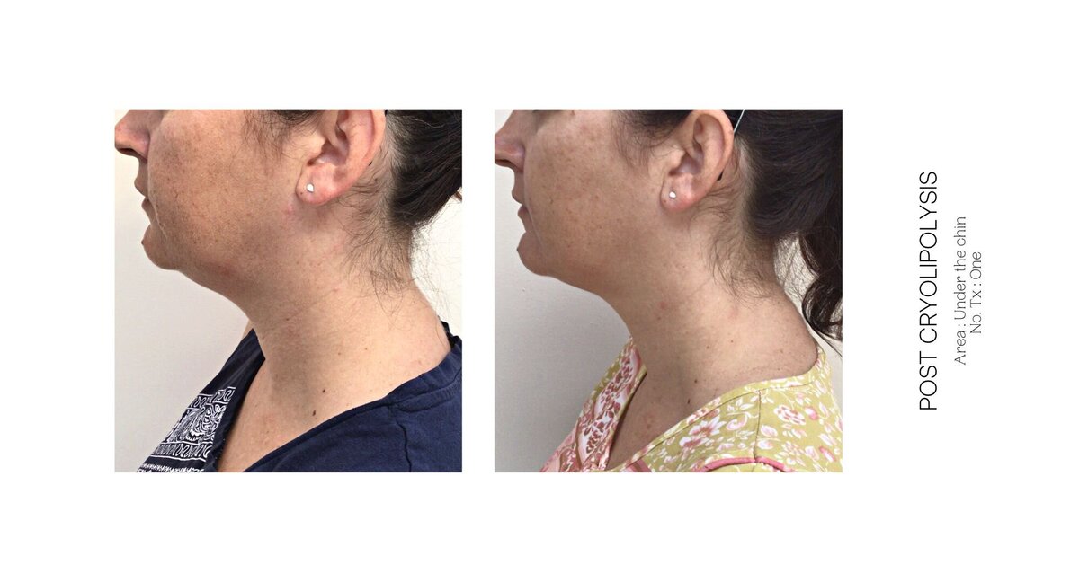 Cryolipolysis Chin Before and After 1