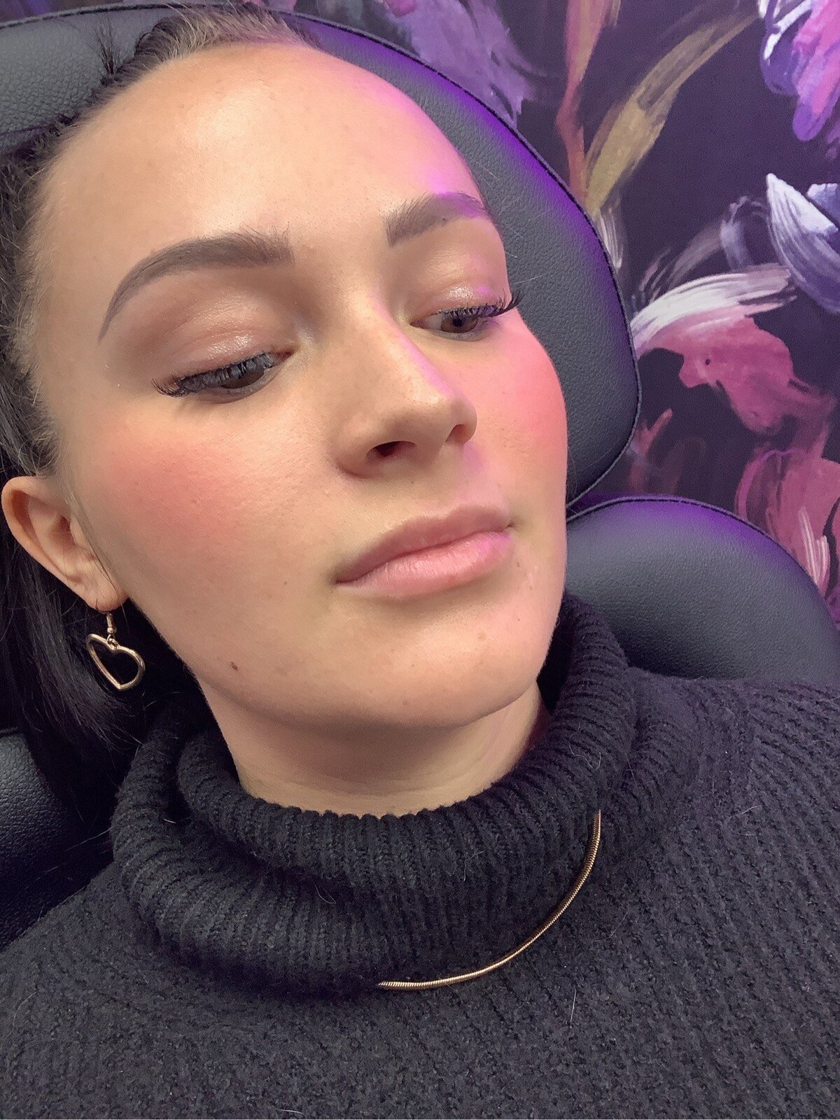 before lip filler