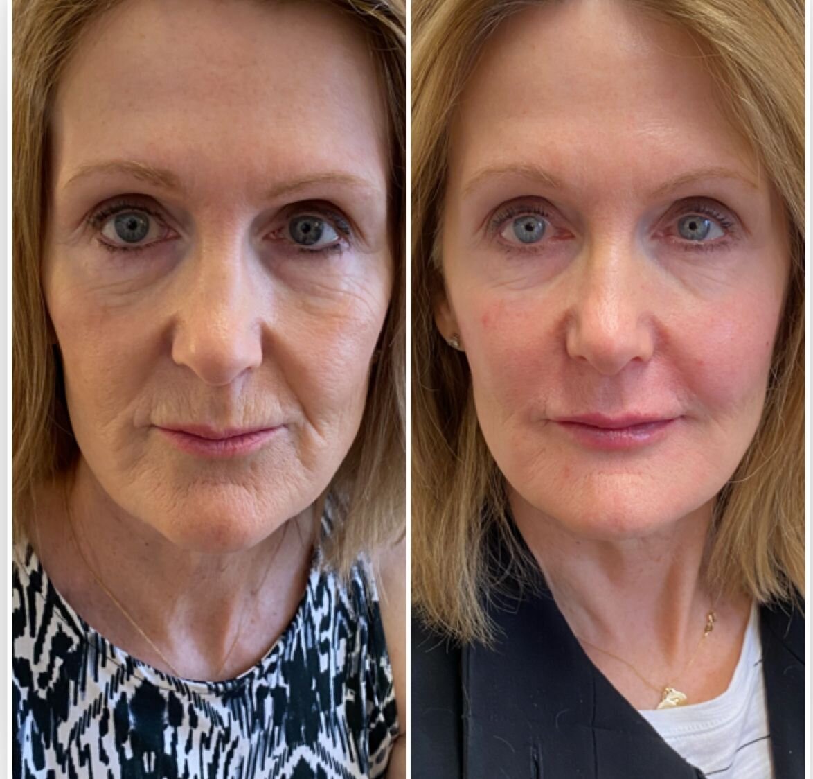 compressed-halo-before-after-06