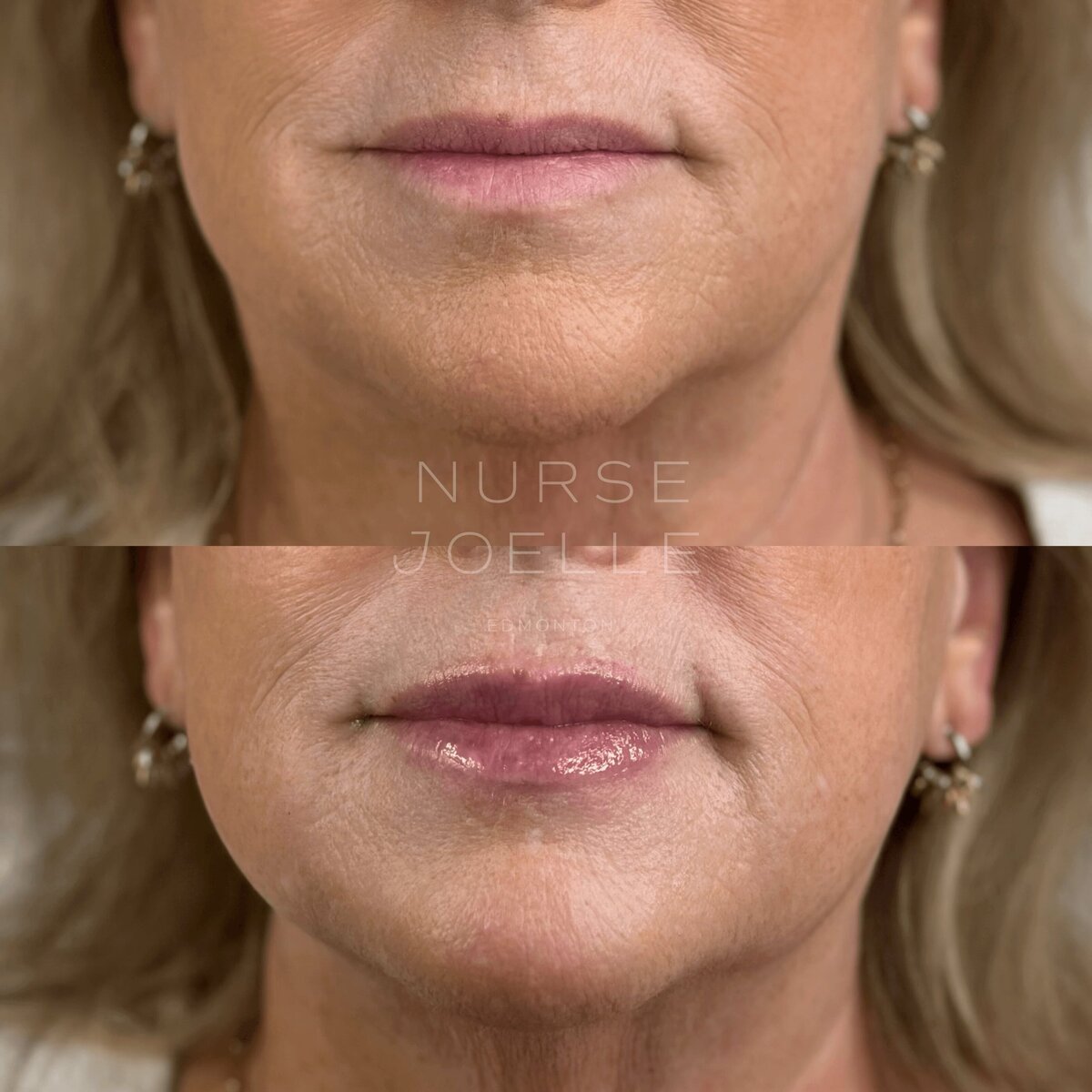 Nurse-Joelle-Cosmetic-Injectables-Before-and-After-7