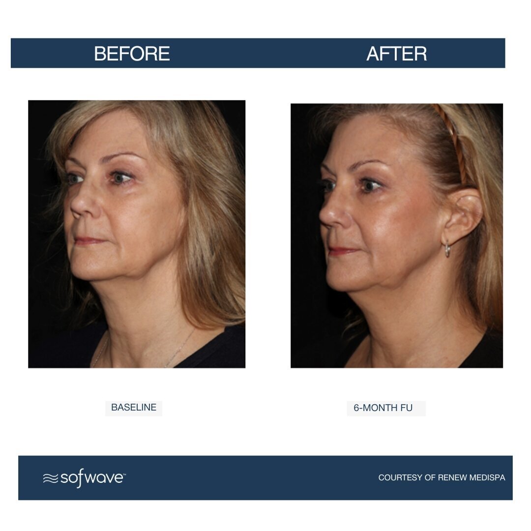 Set-82-Full-Face-Neck (1)