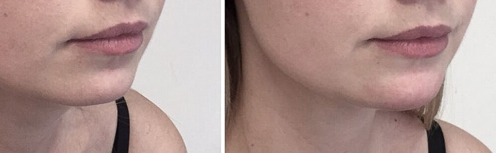 Filler mondhoeken door cosmetisch arts Lizenka Adriaanse in Rotterdam