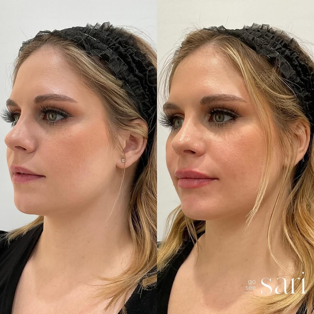 Lip filler before and after_Go See Sari