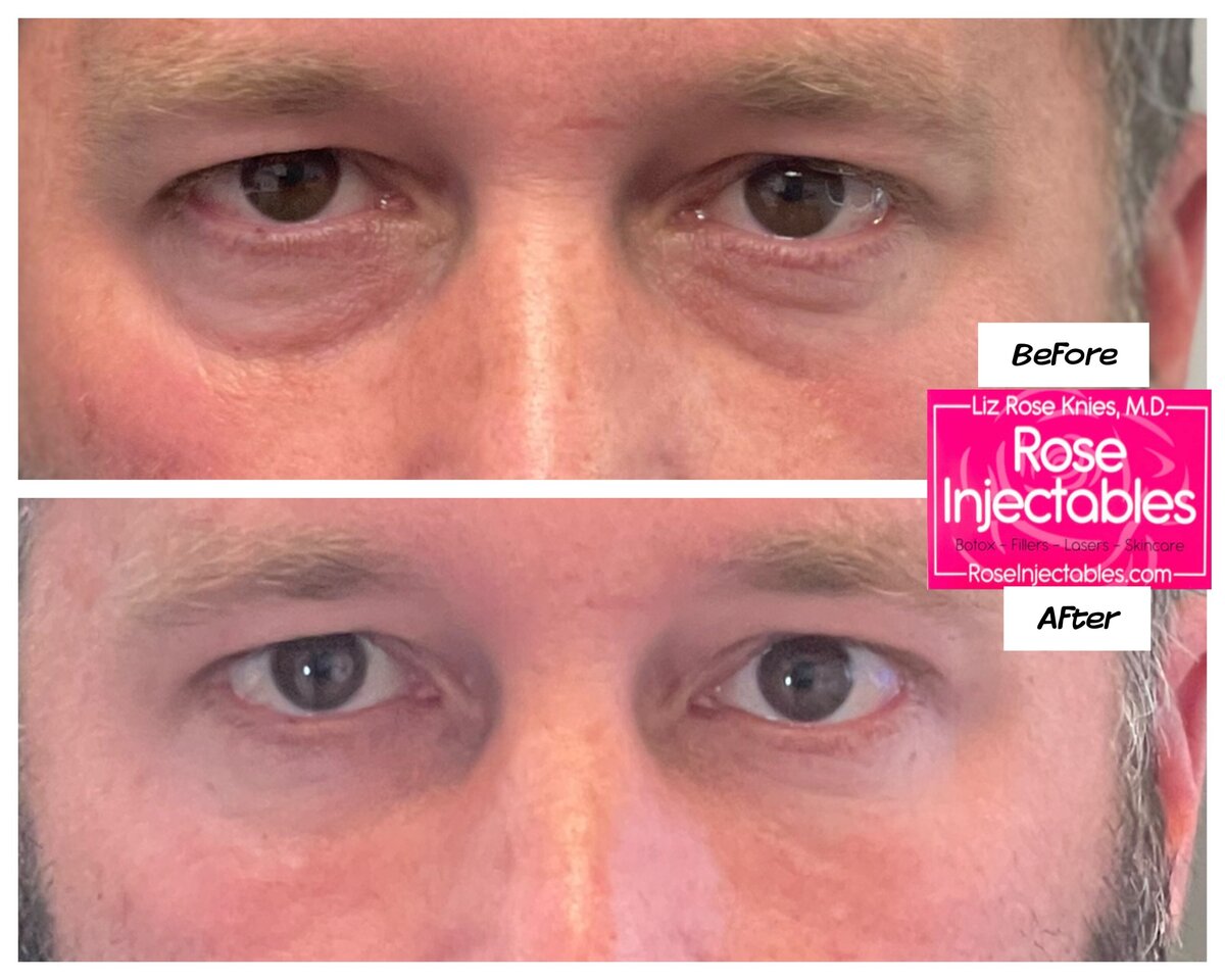 Fillers-by-Rose-Injectables-Before-and-After-Photos-24